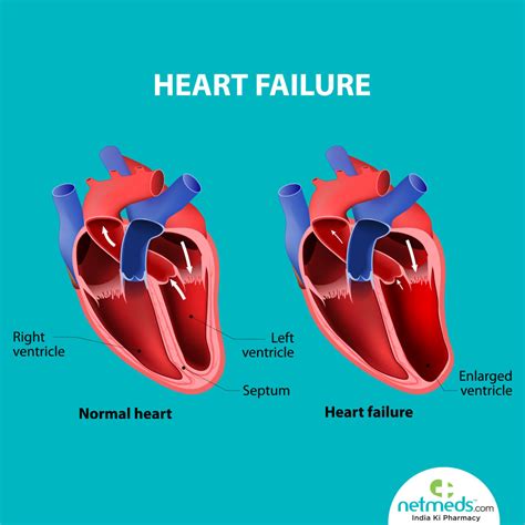 left ventricular dysfunction symptoms.